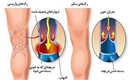 واریس و ملاحظات غذایی آن مقاله